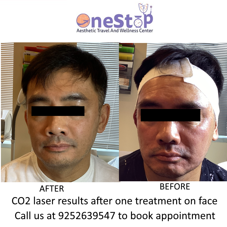 CO2 Laser Skin Resurfacing Face 1 treatment before and after