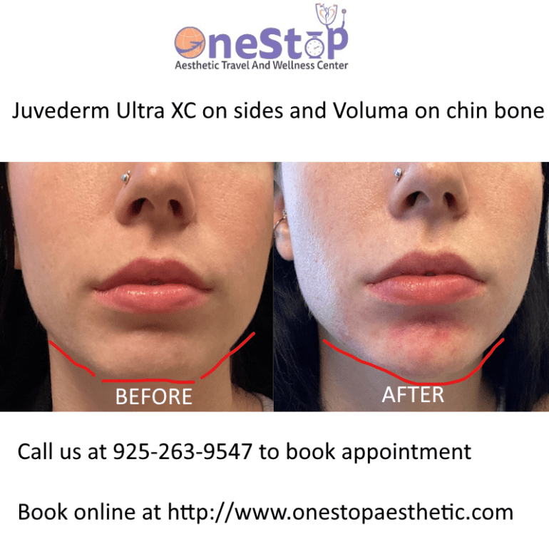 Best Chin filler in Dublin Juvederm Restylane