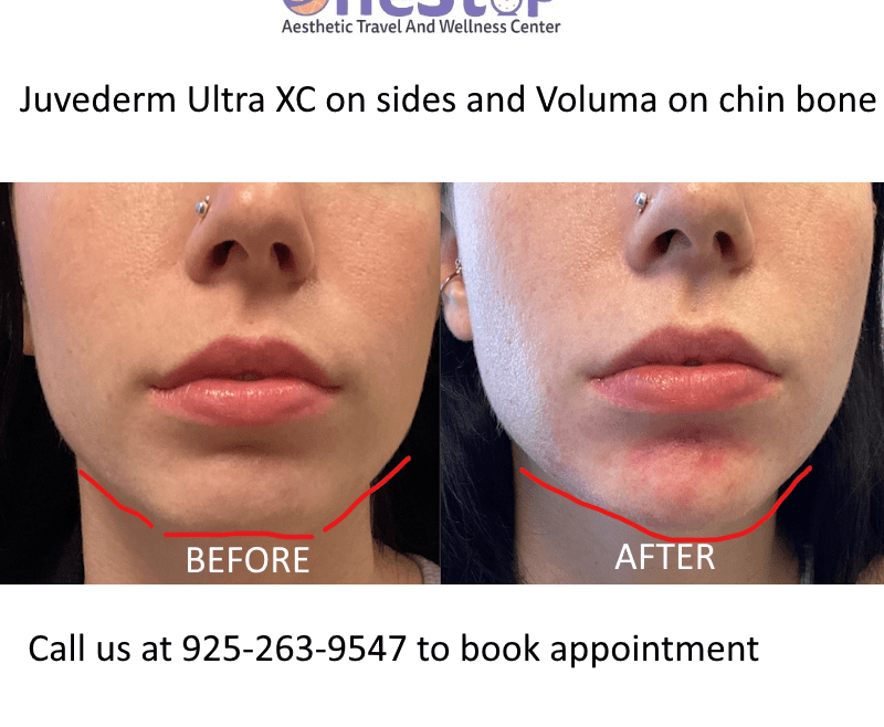 Best Chin filler in Pleasanton 1 Best Chin filler in Pleasanton