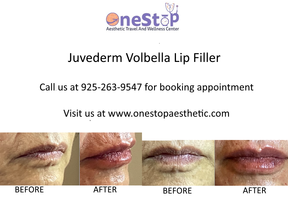 Best Lip Filler in Dublin 9 Juvederm Volbella Lip Filler Before and After 1