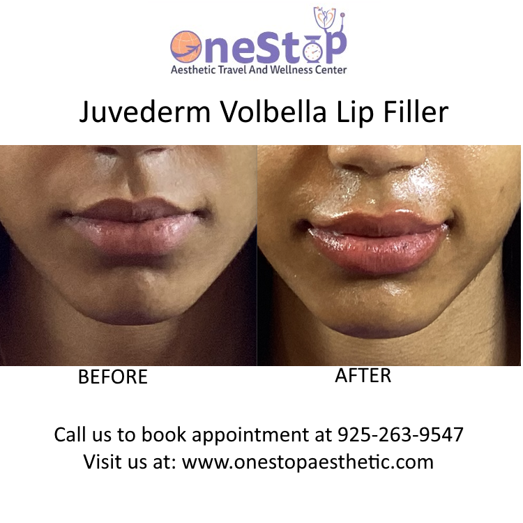 Best Lip Filler in Dublin 7 Juvederm Volbella lip filler - Before and After