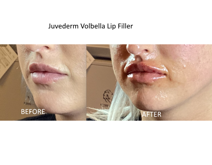 Best Lip Filler in Dublin 8 Juvederm Volbella lip filler - Before and After