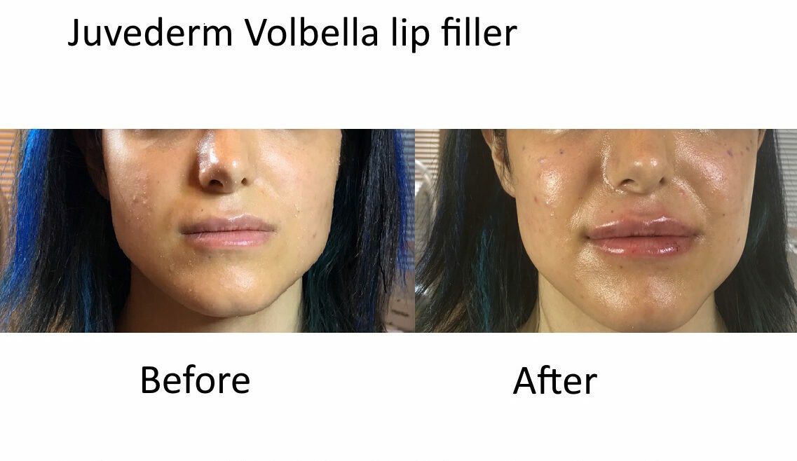 Best Lip Filler in Dublin 1 Best Lip Filler in Dublin