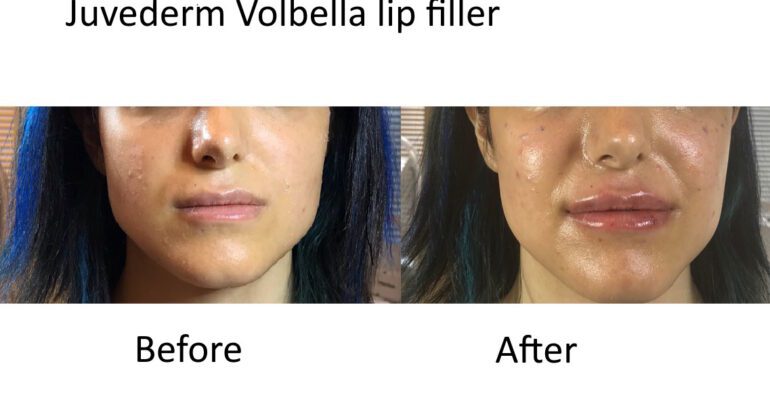 Services 1 Best Lip Filler in Livermore
