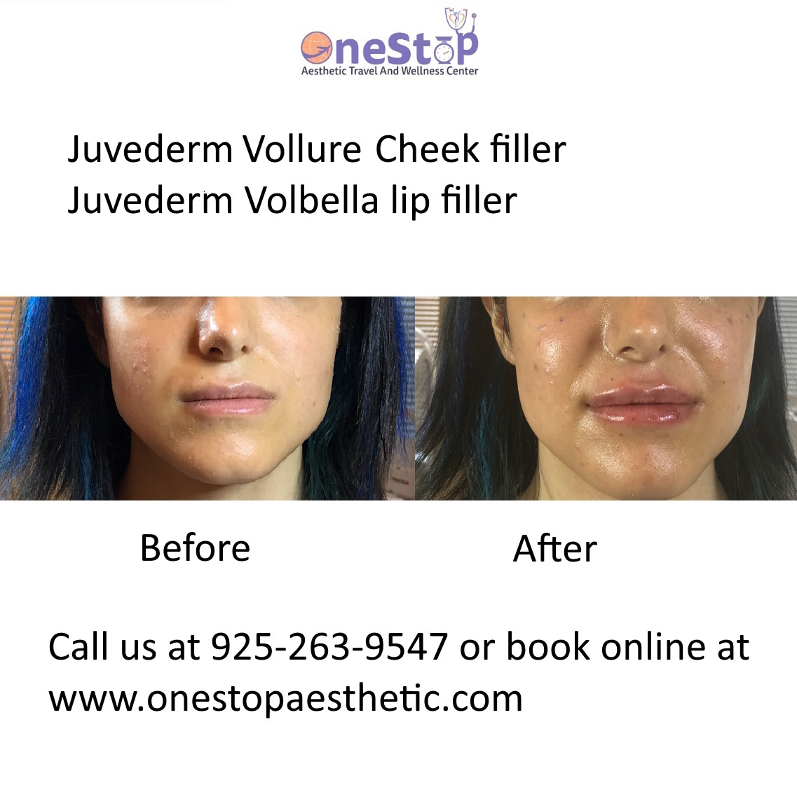 Best Lip Filler in Dublin Juvederm Restylane