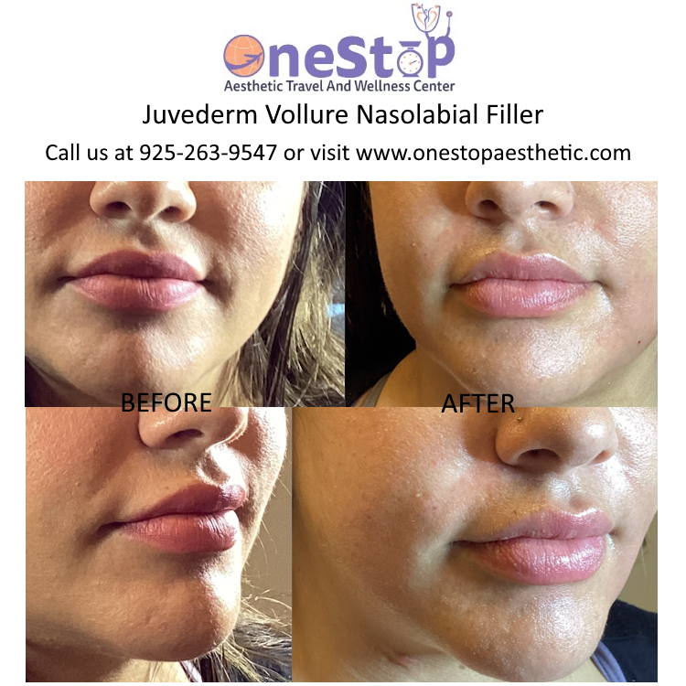 Dermal Fillers - Juvederm, Restylane, Scupltra 32 Juvederm Vollure Nasolabial Filler - Before and After