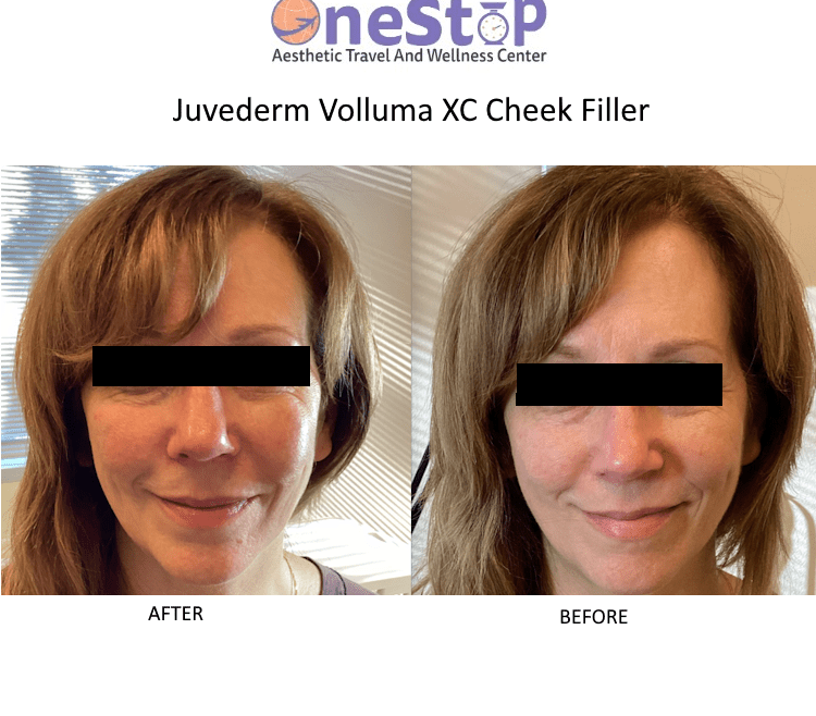 Best Cheek filler in Dublin