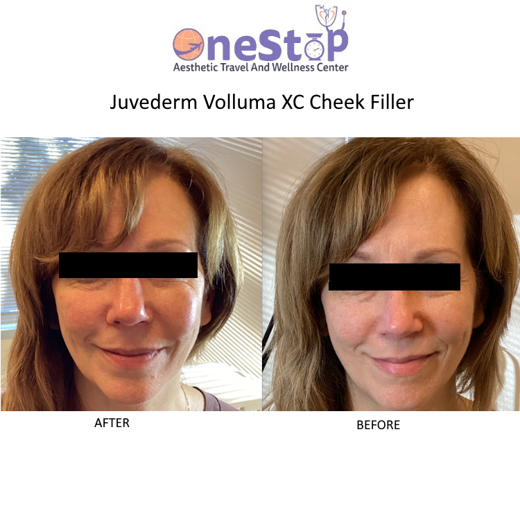 Best Cheek filler in Livermore 7 Cheek filler before and after