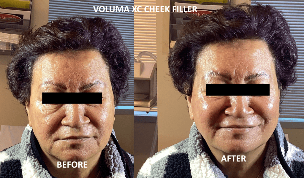 Best Cheek filler in Livermore 8 Cheek filler before and after
