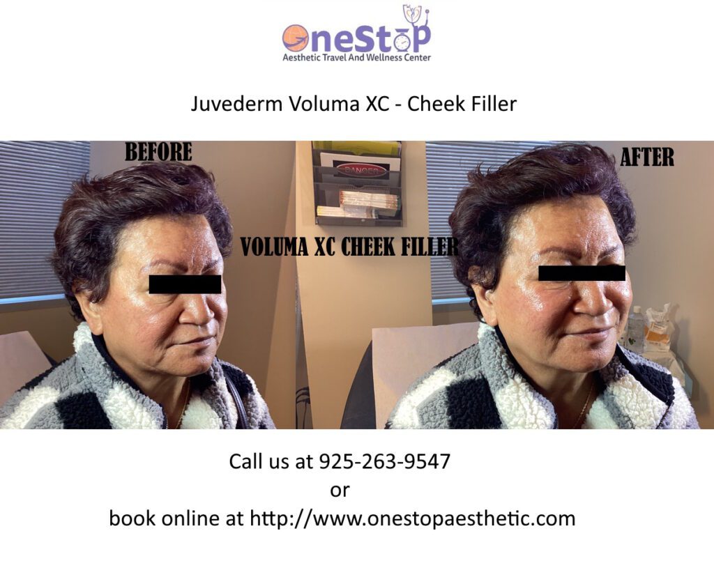Dermal Fillers - Juvederm, Restylane, Scupltra 20 Juvederm Voluma XC - Cheek Filler - Before and After