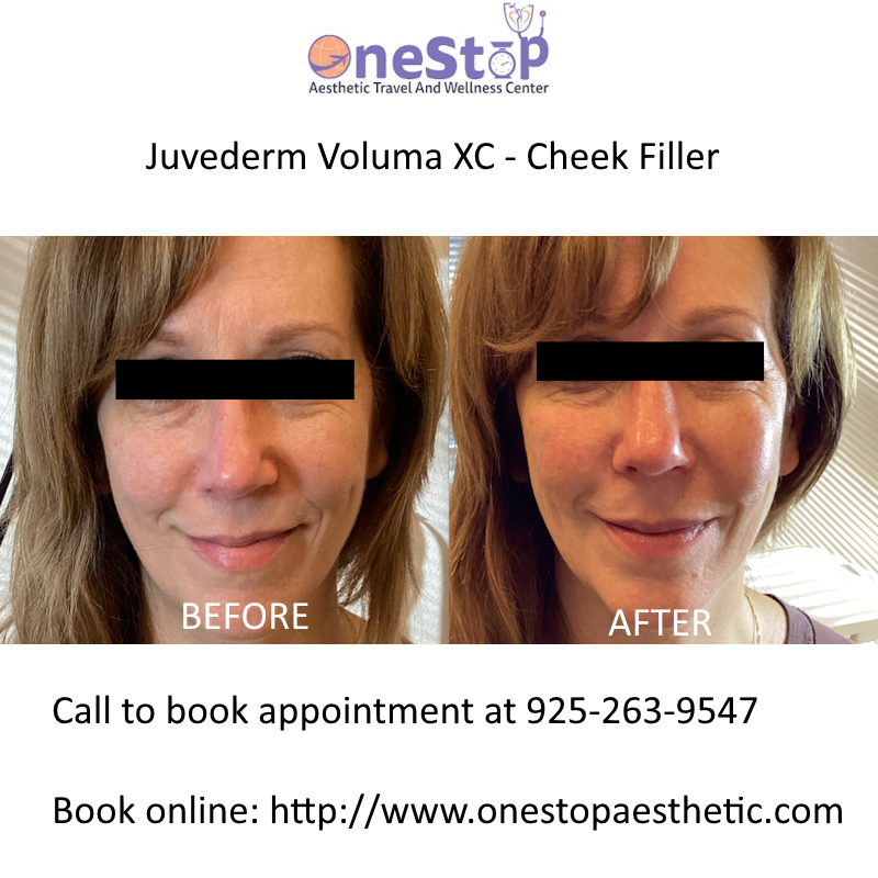Best Cheek filler in Livermore 9 Cheek filler before and after