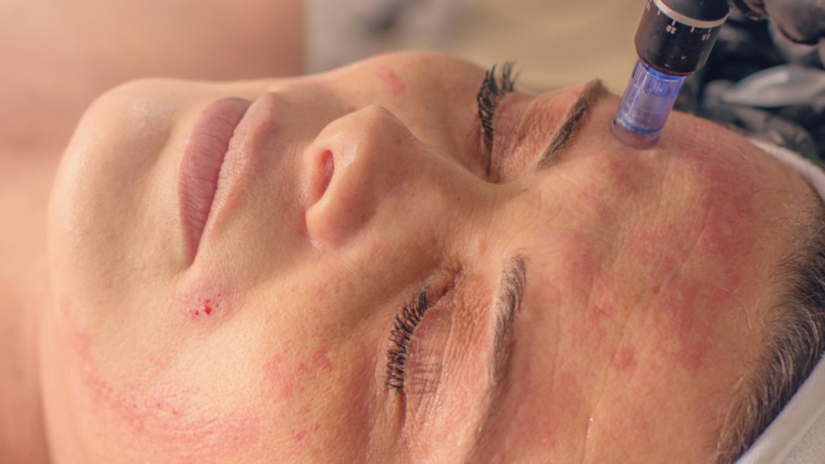 Best Microneedling in Danville, CA