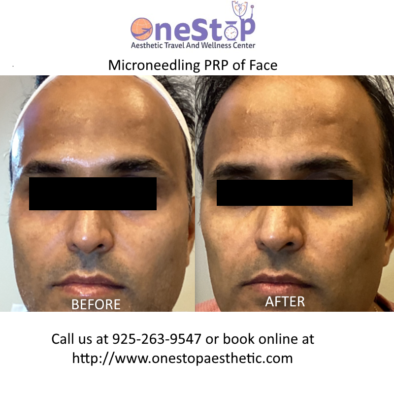 Microneedling PRP 10 Microneedling PRP - Before and After