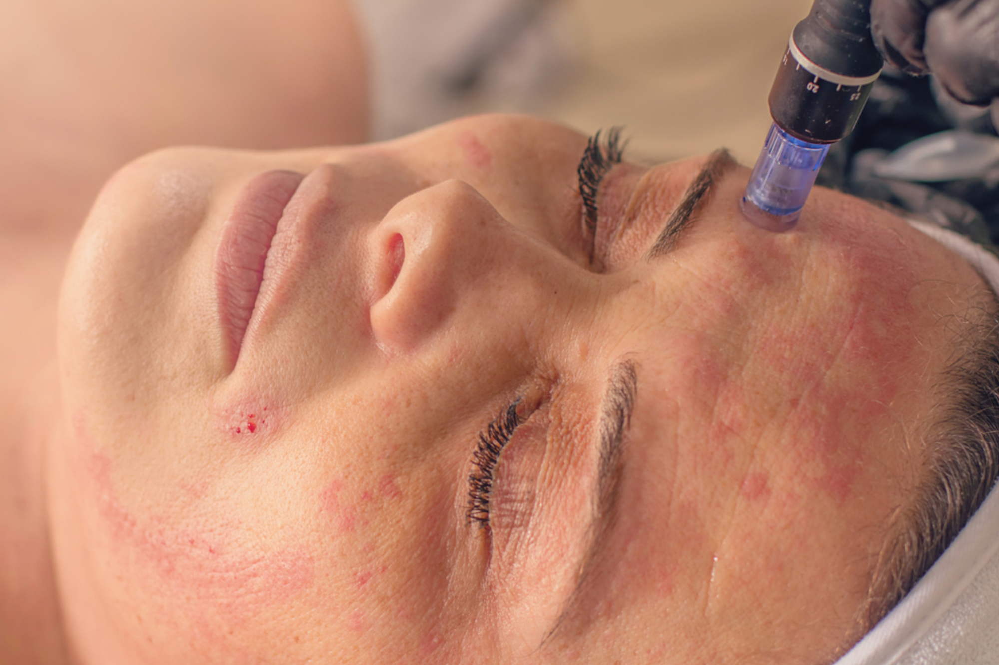 Microneedling 9 Microneedling