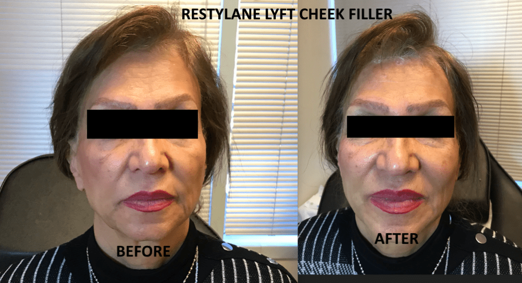 Best Cheek filler in Livermore 11 Cheek filler before and after