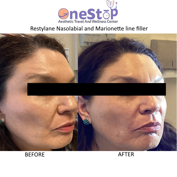 Dermal Fillers - Juvederm, Restylane, Scupltra 31 Restylane Nasolabial Marionette line Filler - Before and After