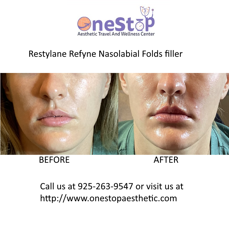 Dermal Fillers - Juvederm, Restylane, Scupltra 33 Restylane Refyne Nasilabial Filler - Before and After