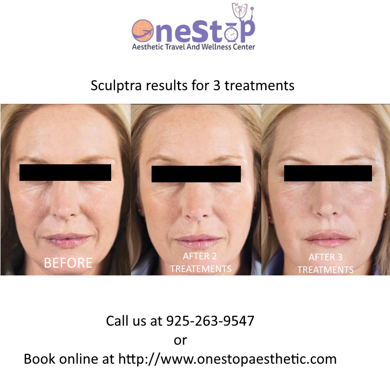 Dermal Fillers - Juvederm, Restylane, Scupltra 35 Sculptra before and after three treatments