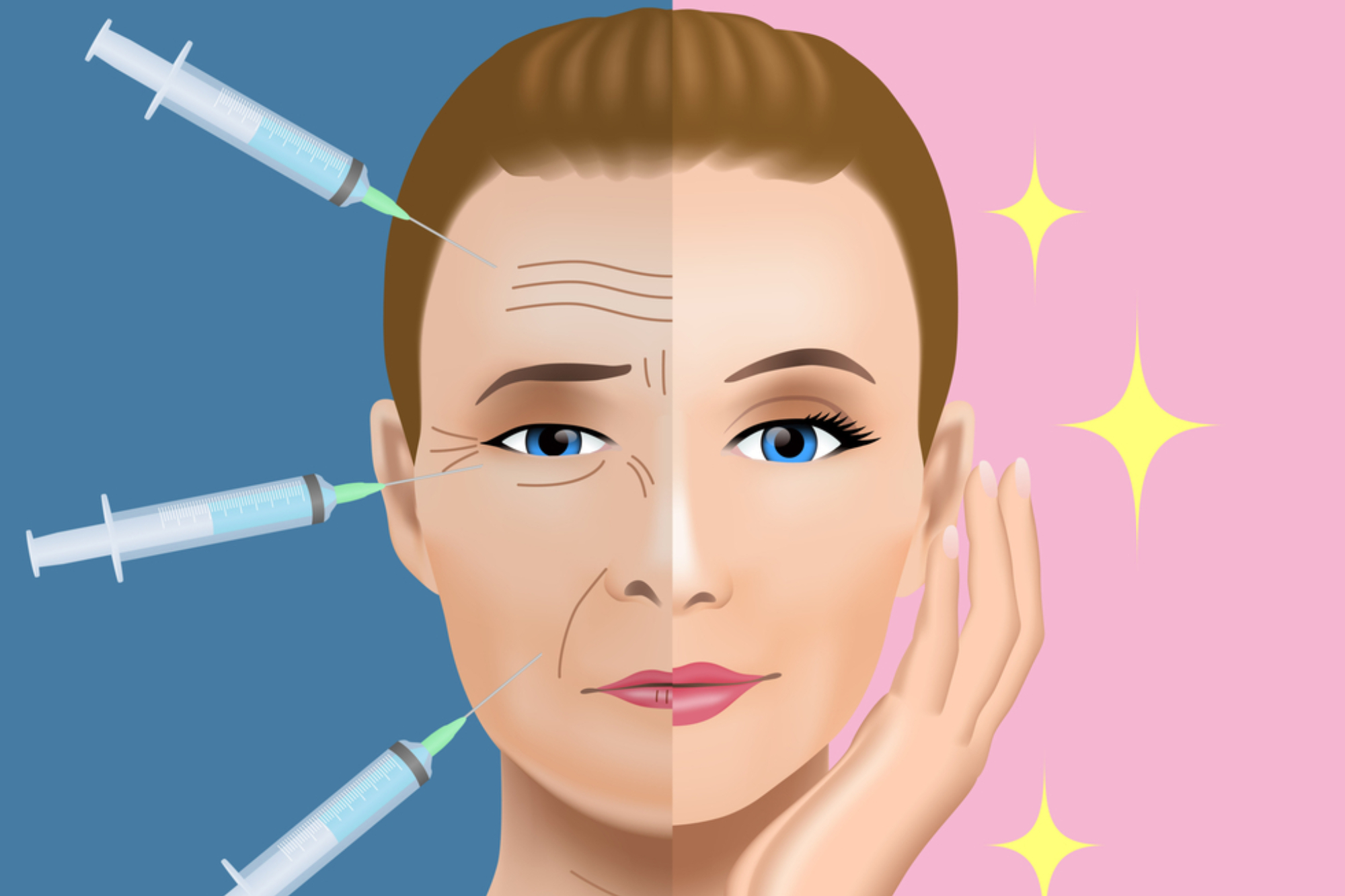 Dermal Fillers - Juvederm, Restylane, Scupltra 19 dermal fillers