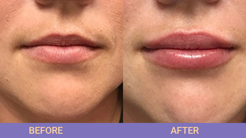 Dermal Fillers - Juvederm, Restylane, Scupltra 29 dermal fillers collarge 6 1