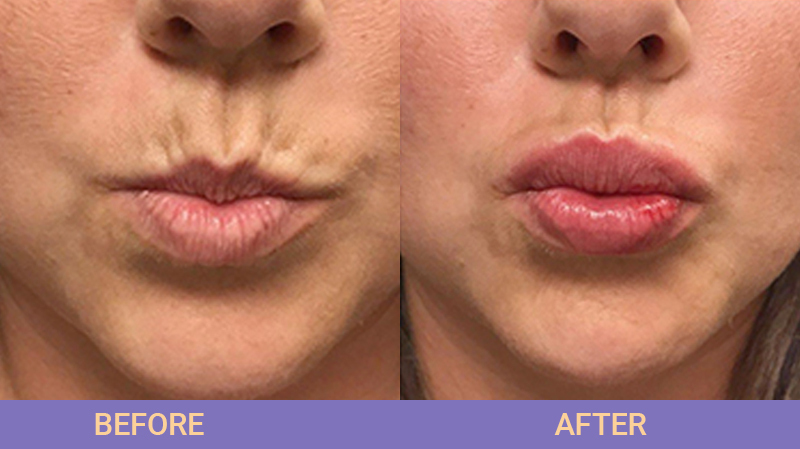 Dermal Fillers - Juvederm, Restylane, Scupltra 30 dermal fillers collarge 7 1