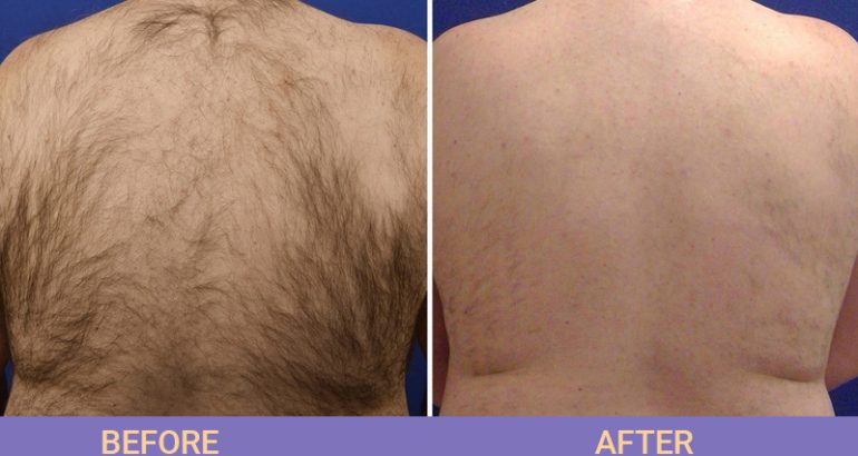 Services 81 Laser Hair Removal near you in Livermore