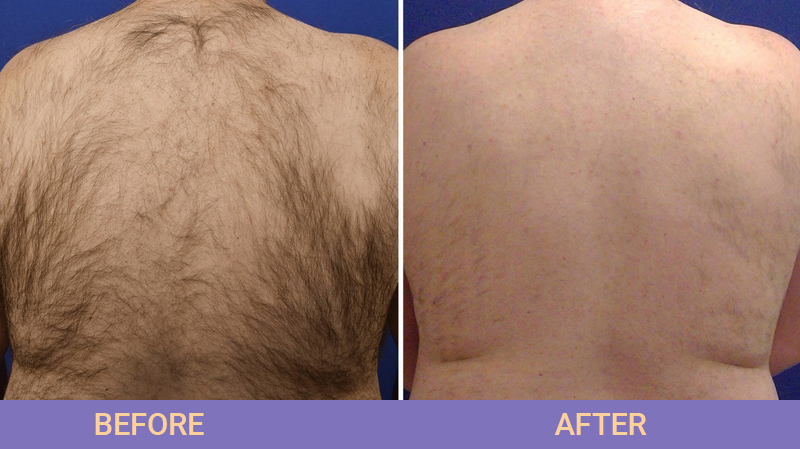 Laser Hair Removal near you in Livermore