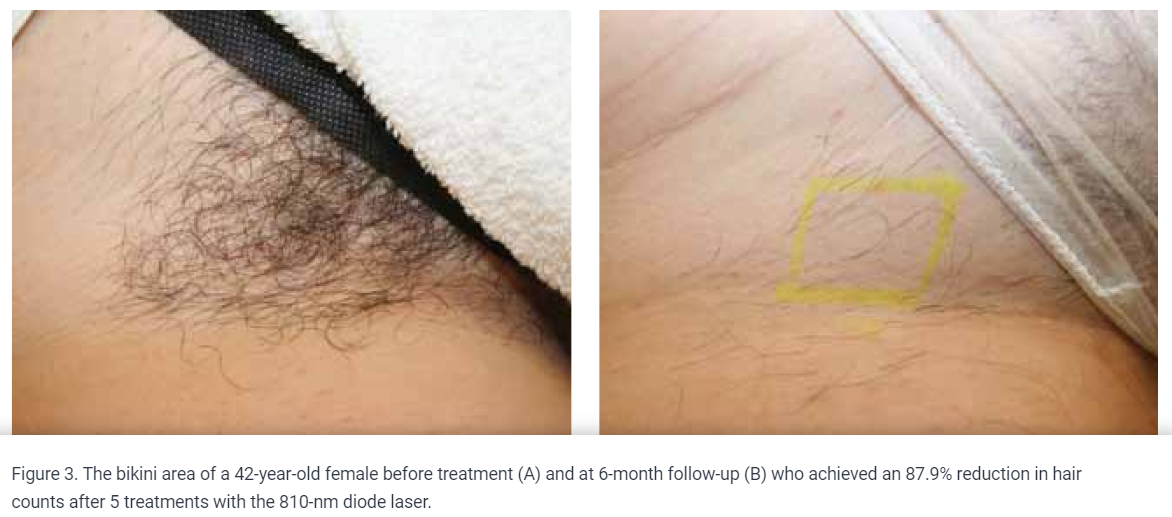 full brazilian laser hair removal before and after photos