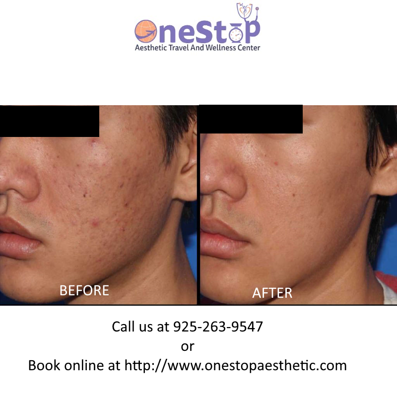 Microneedling PRP 8 Microneedling PRP Face - Before and After