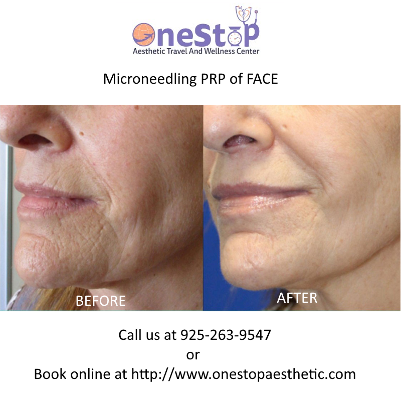 Microneedling PRP 9 Microneedling PRP of Face - Before and After