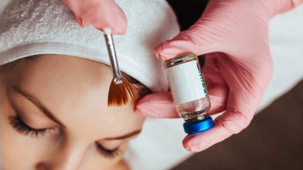Chemical Peel near Pleasanton | Jessners | TCA | Glycolic Acid Peels 1 Chemical Peel near Pleasanton | Jessners | TCA | Glycolic Acid Peels