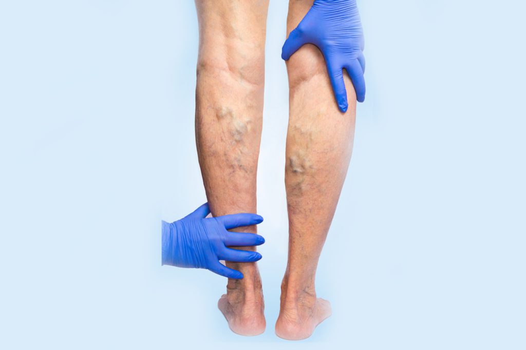 vascular reduction | laser vein treatment