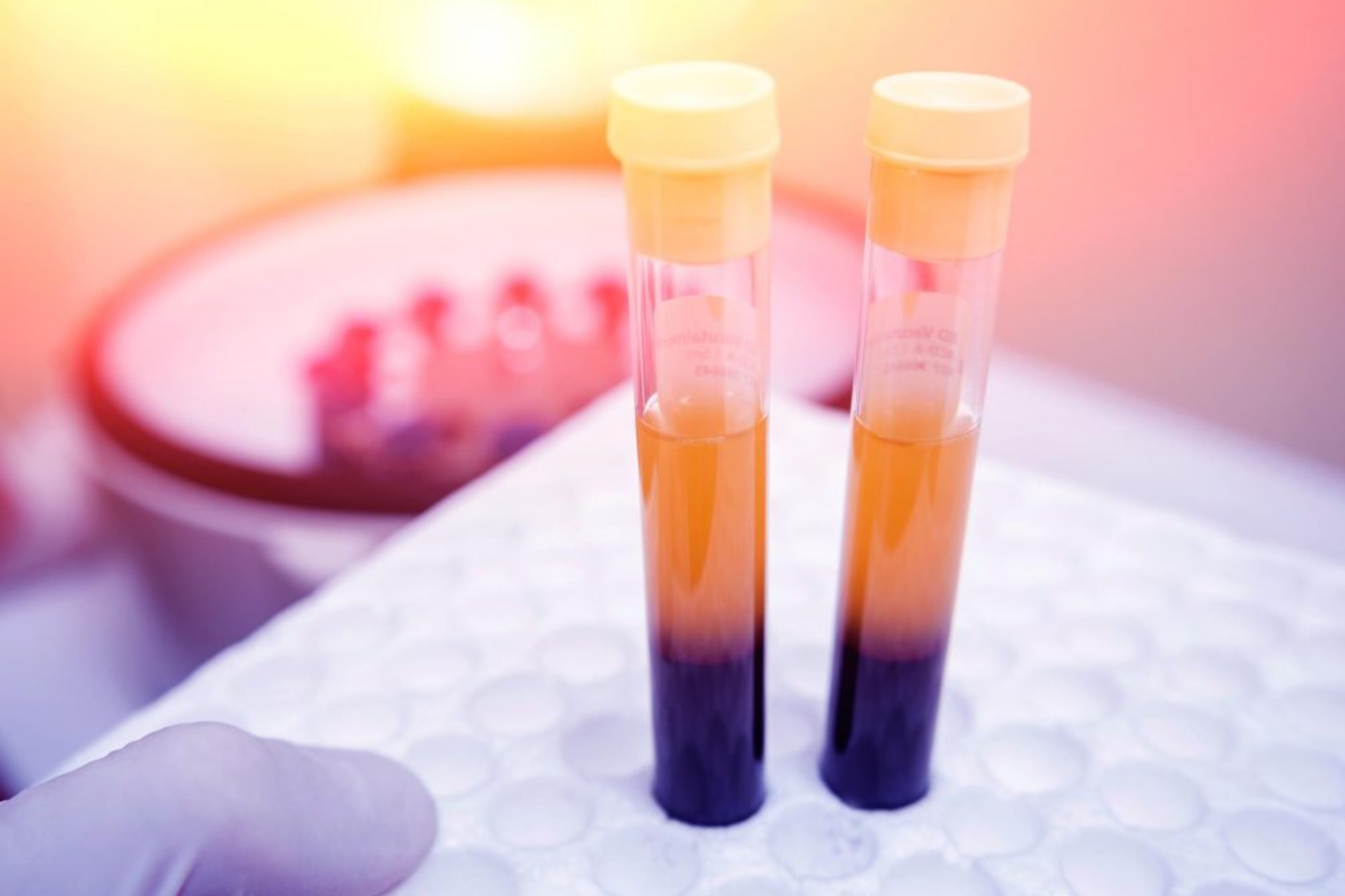 Microneedling PRP 7 Microneedling PRP