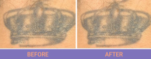 Before and after tattoo removal