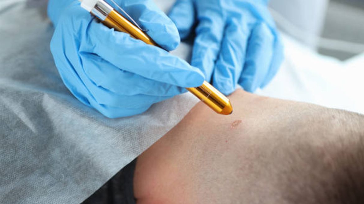 Skin Tag, Wart, Syringoma, Seborrheic Keratosis Removal