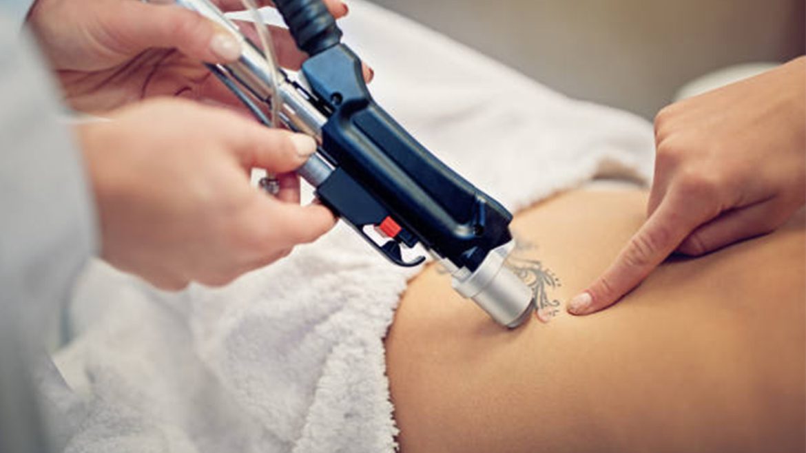 Tattoo Removal