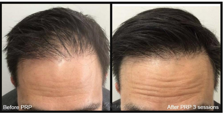 Microneedling PRP with injections results