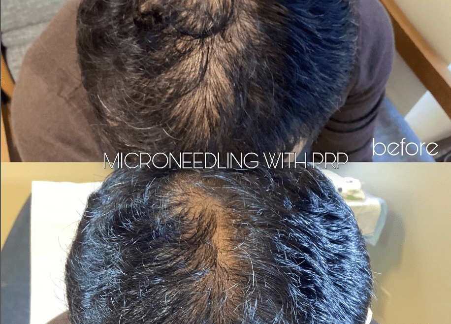 Hair Restoration deals near you in Pleasanton, Dublin, Livermore, Danville