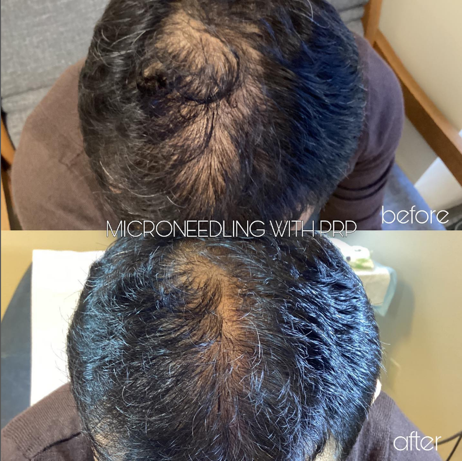 Hair Restoration deals near you in Pleasanton, Dublin, Livermore, Danville 3 Hair restoration