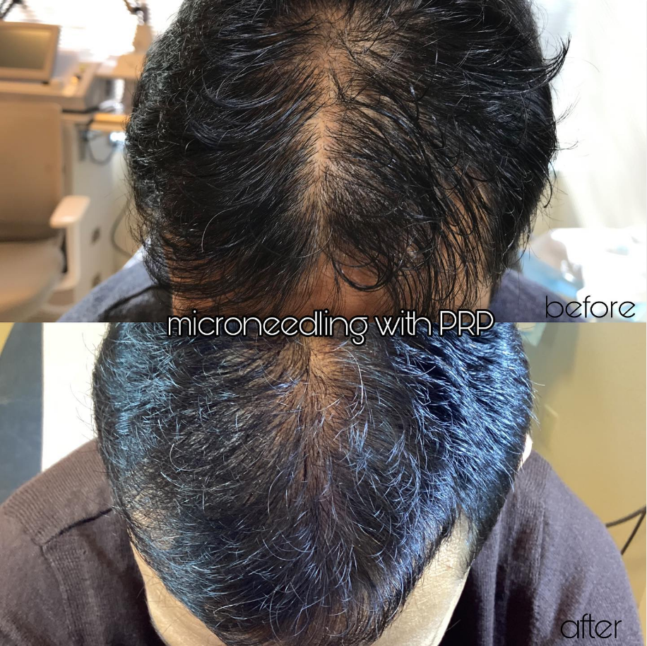 Microneedling PRP Hair Restoration Before and After