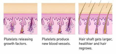 How Hair restoration treatment works?