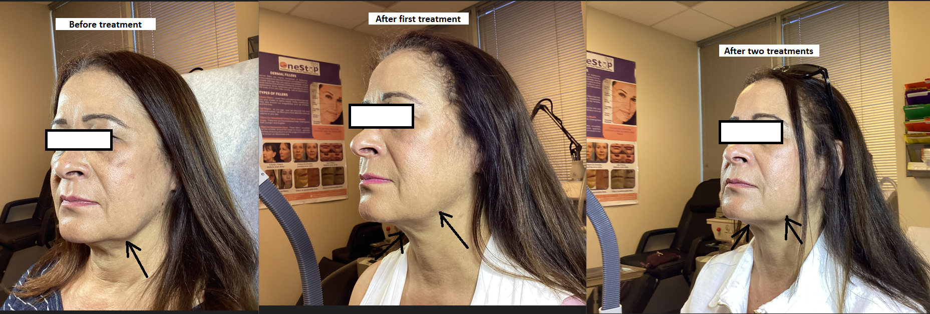 Kybella before and after 1