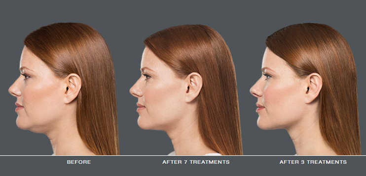 Kybella -  double chin reduction treatment