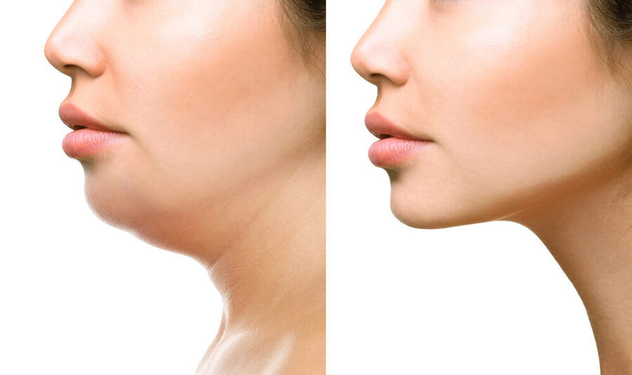 Kybella