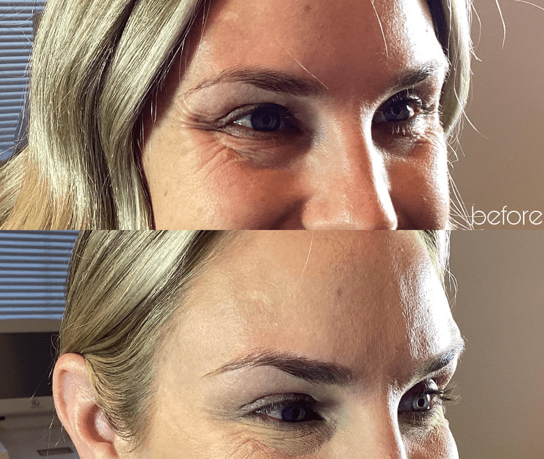 Best Botox in Dublin