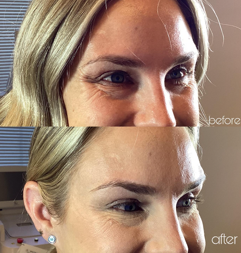 Botox crow's feet before and after