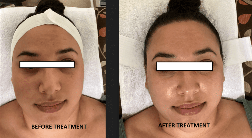 Hydrodermabrasion, Diamond Microdermabrasion deals near you in Pleasanton, Dublin, Danville, Livermore 9 Hydrodermabrasion Before and After
