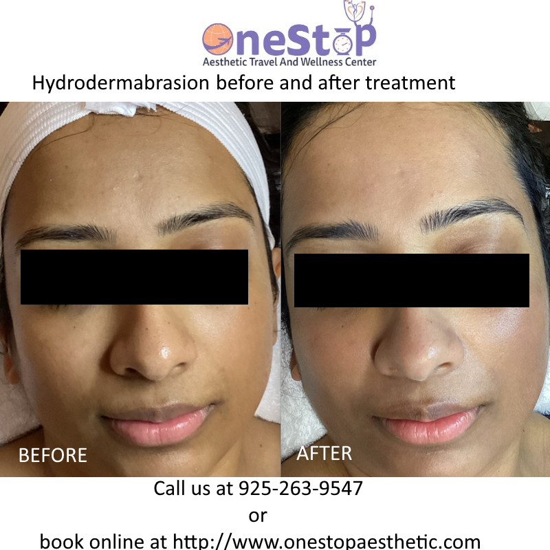 Hydrodermabrasion, Diamond Microdermabrasion deals near you in Pleasanton, Dublin, Danville, Livermore 7 Hydrodermabrasion Before and After