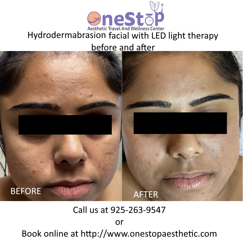 Hydrodermabrasion, Diamond Microdermabrasion deals near you in Pleasanton, Dublin, Danville, Livermore 8 Hydrafacial with LED therapy Before and After